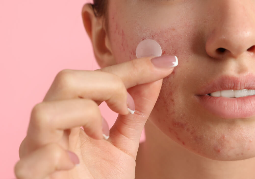 What Are Hydrocolloid Patches? And Do They Work?