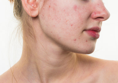 How to Use and Apply a Pimple Patch