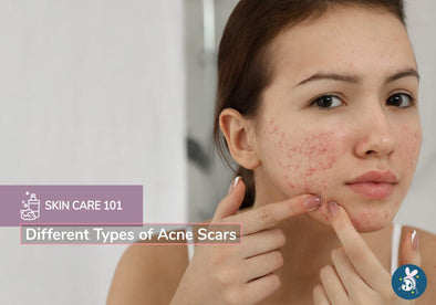 Skincare 101: Different Types of Acne Scars