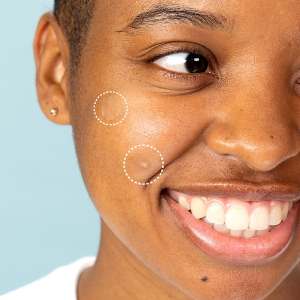 Spot Fighter Duo Blemish Patch Subscription- for Acne and Pimples