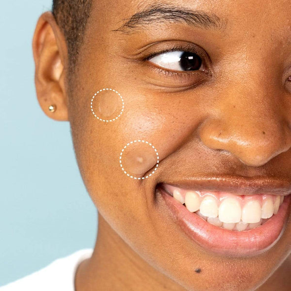 Spot Fighter Duo Blemish Patch Subscription- for Acne and Pimples [RENEWAL]