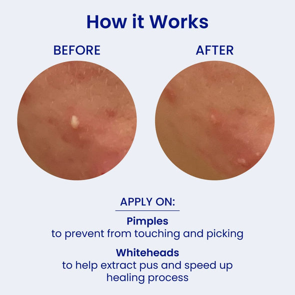 Spot Fighter Blemish Patches- for Acne and Pimples Duo (20% Off)
