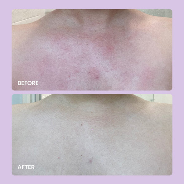 Acne Solutions Kit